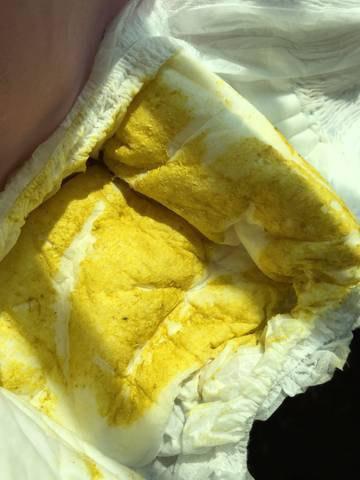 第三代助孕宝宝拉肚子什么症状